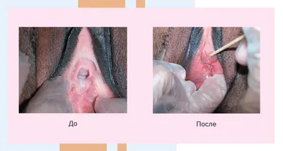 Гименопластика: цена операции восстановление девственной плевы в Москве