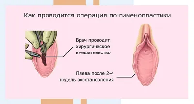 Гименопластика: цена операции восстановление девственной плевы в Москве