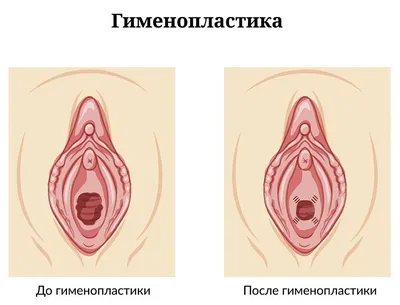 Гименопластика лечение, причины, симптомы и диагностика