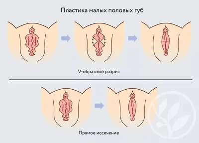 Гименопластика - Восстановление девственности в Ульяновске