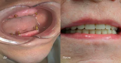 Фото до и после процедуры имплантации зубов all-on-4 в клинике Селин