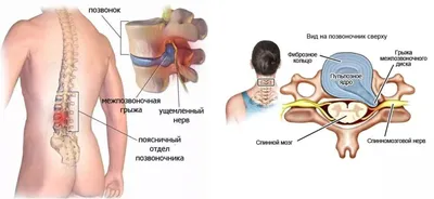 Гимнастика при грыже поясничного отдела позвоночника - sportdush.ru