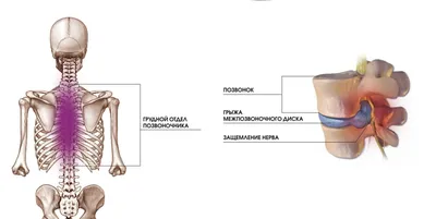 Грыжа поясничного отдела позвоночника ✓: симптомы, признаки и причины,  диагностика и лечение