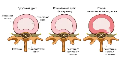 Упражнения для лечения грыжи межпозвонкового диска