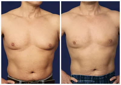 Гинекомастия операция фото до и после фото
