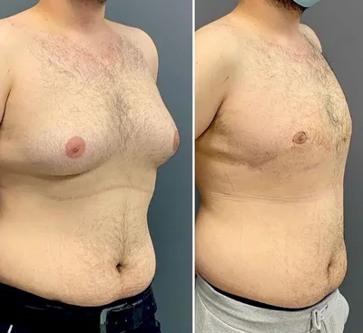 Фото до и после операция при гинекомастии | Bookimed