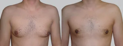 Пластическая операция груди у мужчин - гинекомастия | Asklepion