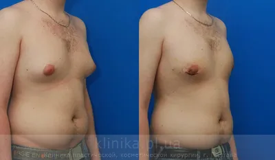 ᐉ Фото до и после — лечение гинекомастии, фотографии до и после операции  лечение гинекомастии, фото результатов операции