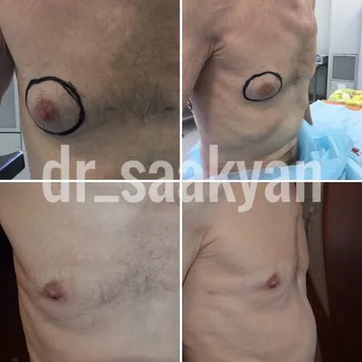 Иссечение гинекомастии - Севак Саакян, пластический хирург от «А» до «Я»