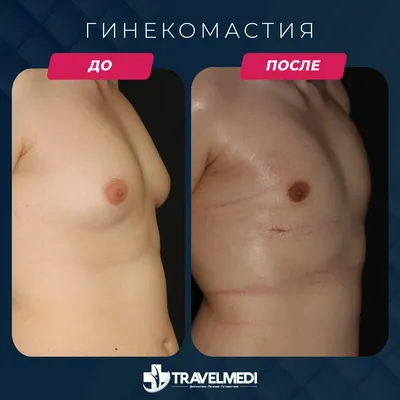 Операция гинекомастия при увеличенной железе, Киев