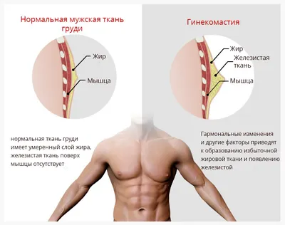 Гинекомастия - Клиника пластической хирургии и косметологи Эпиона Медикус