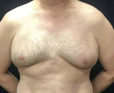 MEDAS Medical Center - Гинекомасти́я — увеличение грудной железы у мужчин с  гипертрофией желез и жировой ткани. Размер увеличения грудной железы может  быть различен — от 1 до 10 см. На фото