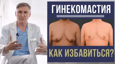 Удаление гинекомастии, уменьшение груди у мужчин в Киеве | Доктор Зыков