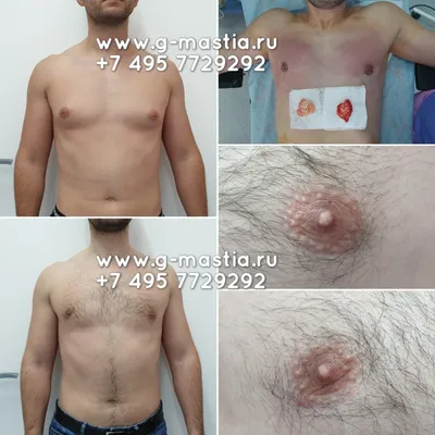 Фотогалерея До и После, Лечение гинекомастии у мужчин
