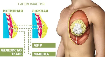 Гинекомастия: симптомы, методы лечения - Клиника Доктора Гришина