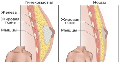 Коррекция гинекомастии у мужчин (фото до и после) – Исамутдинова Г. М.