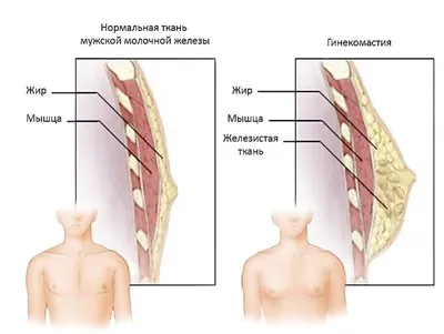 Гинекомастия у мужчин - симптомы, лечение, удаление гинекомастии в Москве