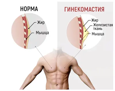 Гинекомастия: Лечение, Операция по удалению, маммология для мужчин ᐉ Цена в  Киеве | Клиника выходного дня