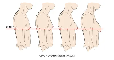 Гинекомастия подтягивание, увлажнение, подтягивание тела, имбирное  подтягивание кожи для мужчин и женщин | AliExpress