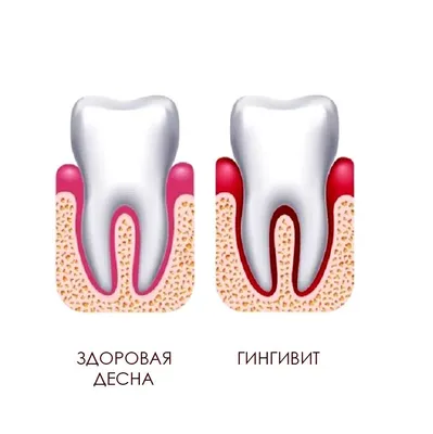 Гингивит: не дай болезни прогрессировать