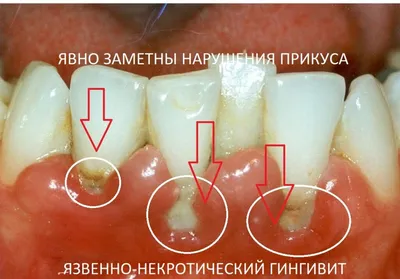 Заболевания десен у детей