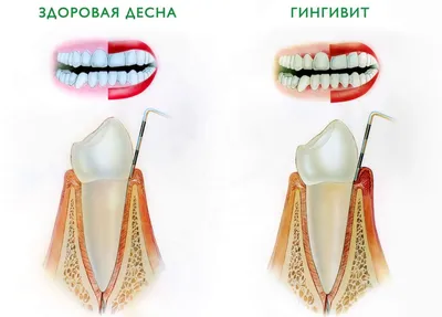 Лечение пародонтита у детей - Стоматология