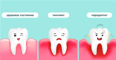 Гингивит: клинические симптомы заболевания десен у взрослых, диагностика и  лечение