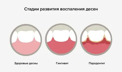 Гингивит у детей, лечение гингивита в СПб - Euromed Dental