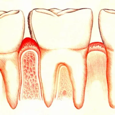 Гингивит 😢 Лечение гингивита (Киев) 🔹 Цены в клинике Healthy Dent