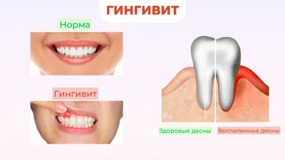 Гингивит у детей (воспаление десны у ребенка) – как лечить