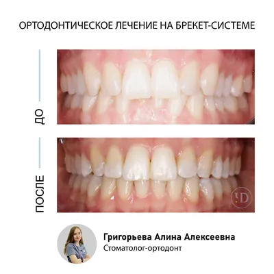 Гингивопластика или пластика десны : фото до и после | Стоматология в СПб  «Чистое Дыхание»