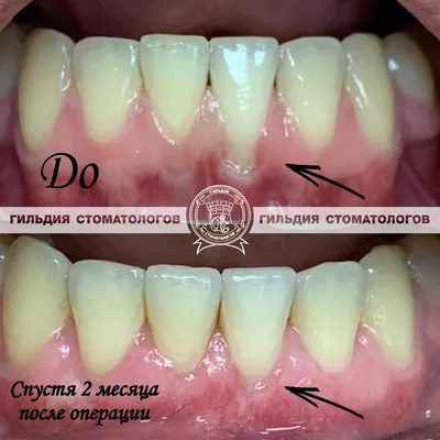 Гингивопластика зубов (до/после) | Работы врача Юдина О.В. | Наши работы