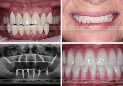 Фото до и после стоматологии | Клиника Damas Clinic