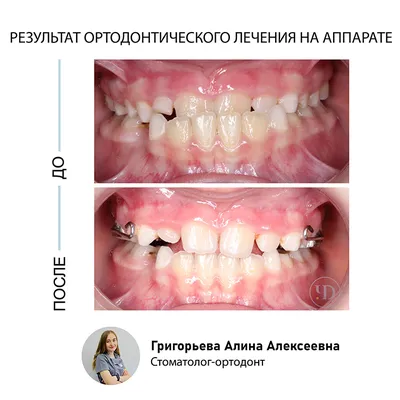 Гингивопластика или пластика десны : фото до и после | Стоматология в СПб  «Чистое Дыхание»