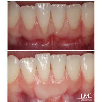 Пластика мягких тканей в Минске | Вестибулопластика, гингивопластика,  пластика десны.