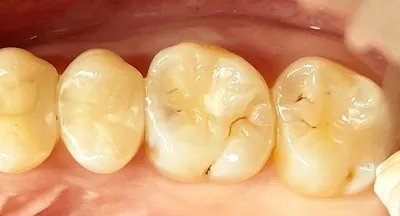 В каких случаях необходима гингивопластика | Смайл Эстетик - сеть  стоматологий | Дзен