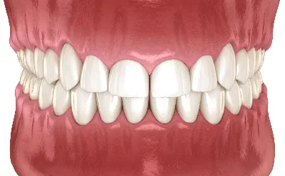 Пластика десны в Киеве по выгодной цене: гингивопластика в  стоматологической клинике Complex Dent