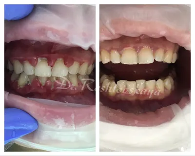Имплантация зубов в Краснодаре - установка имплантов по доступной цене под  ключ | Доктор Лав