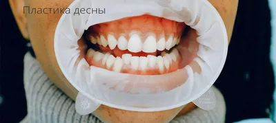 ИМПЛАНТАЦИЯ | БРЕКЕТЫ | ВИНИРЫ | СЕМЕЙНАЯ СТОМАТОЛОГИЯ | АЛМАТЫ on  Instagram: \"Гингивопластика 8 верхних зубов до и после в @dr.usainov_clinic  Скорректировали видимость эмали зуба и формы! Стоимость - 6 тыс тг.