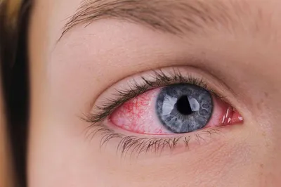 8 причин покраснения глаз – Семейная клиника «Доктор АННА»