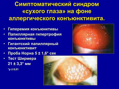 Глазка офтальмологический центр - 💥 👀 Синдро́м Шегре́на - хроническое  аутоиммунное воспалительное заболевание, при котором слизистые оболочки,  особенно полости рта и глаз, становятся чрезвычайно сухими. Более 90 %  больных составляют женщины. Пик