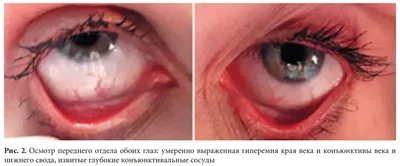Рис. 2. Осмотр переднего отдела обоих глаз: умеренно выраженная гипере…