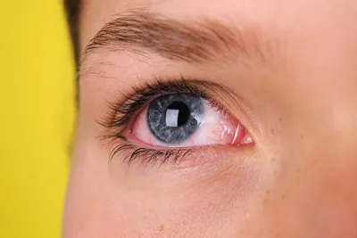 Красные глаза: какие могут быть причины гиперемии конъюнктивы?