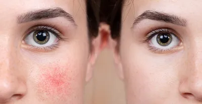 Розацеа и себорейный дерматит - как справиться с покраснениями и  воспалением кожи лица. Metro