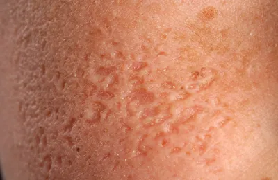 Гусиная кожа или дерматит?