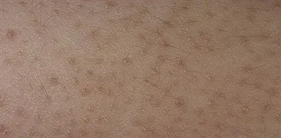 Гусиная кожа – что нужно знать о фолликулярном гиперкератозе- Здоровье 24