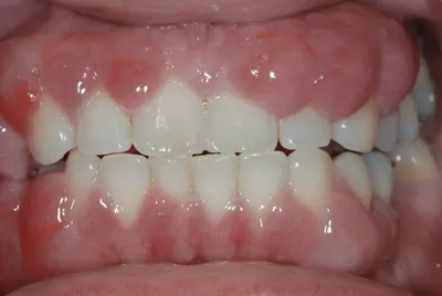 Гиперплазия десны | Портал о зубах Симпладент | Дзен