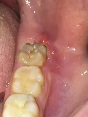 Гиперплазия эмали зубов | Диагностика, лечение, цена