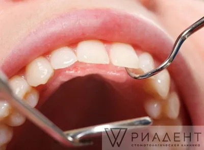 Лечение и полоскание десен или зубов солью