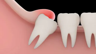 Гипоплазия эмали зубов [причины, лечение, формы и виды]